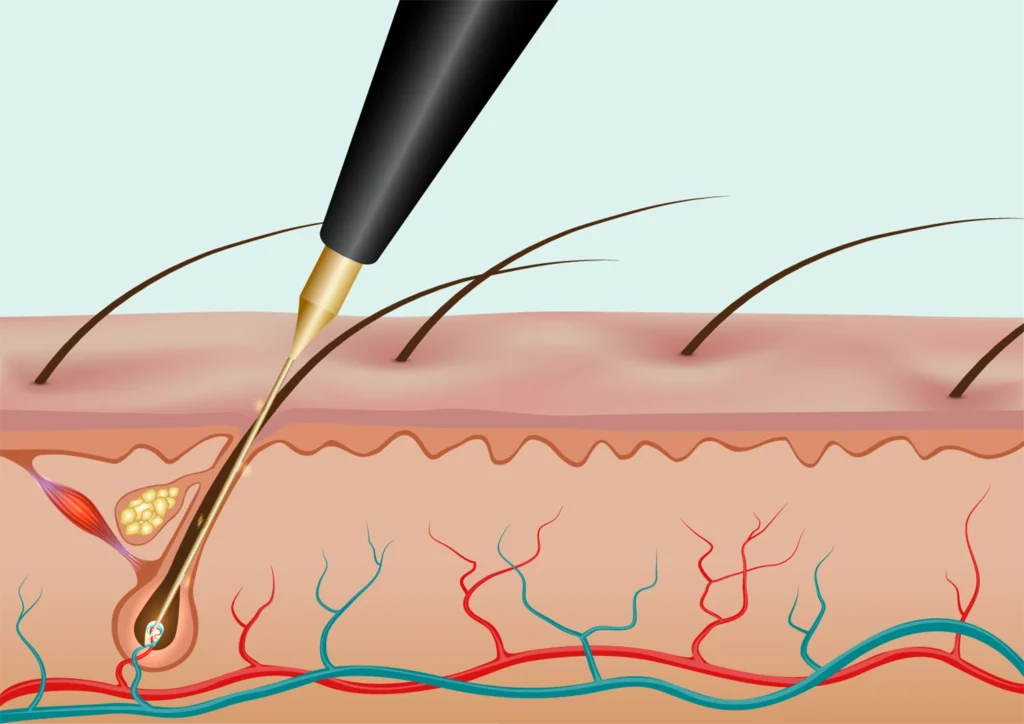 Electrolysis hair removal technology